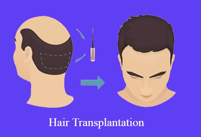 Best Hair Transplantation Service in Hyderabad