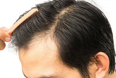 Hair Transplant Clinic in Hyderabad